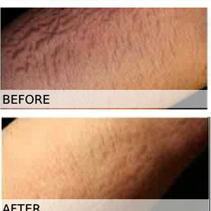 stretch mark removal cream before and after